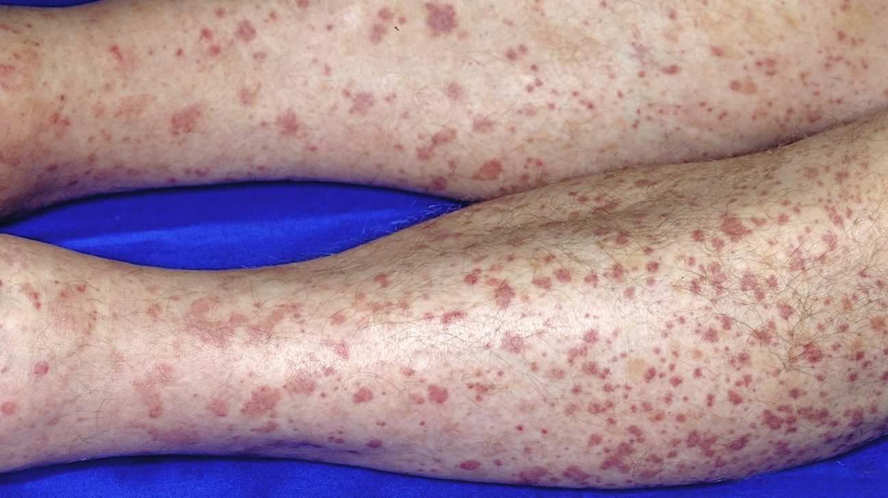 Leukocytoclastic Vasculitis