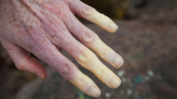 the-common-signs-and-symptoms-of-lupus-rm-722x406